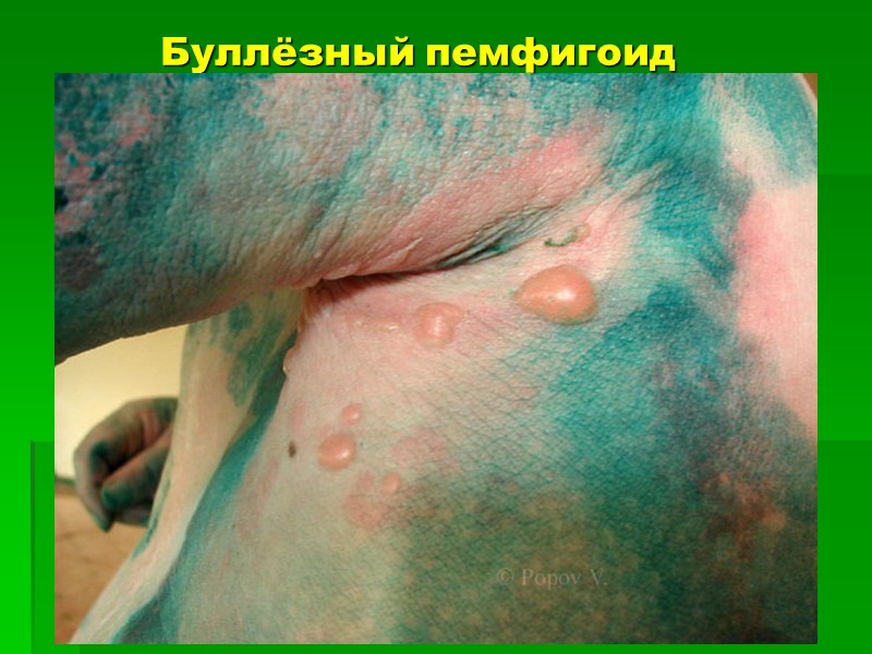 Буллёзный пемфигоид